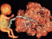 پاورپوینت بیماری های تروفوبلاستیک حاملگی (GTD) (ppt) 30 اسلاید