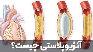 پاورپوینت آنژیوپلاستی (ppt) 30 اسلاید